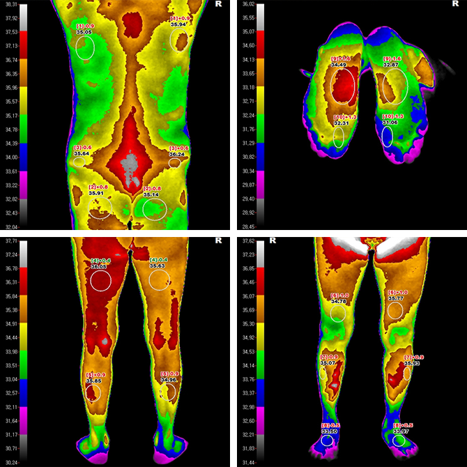 ③ 디지털 적외선 신경촬영(DITI)