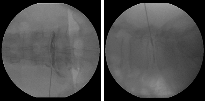 ④ 추간판조영술(Provocation Discography)