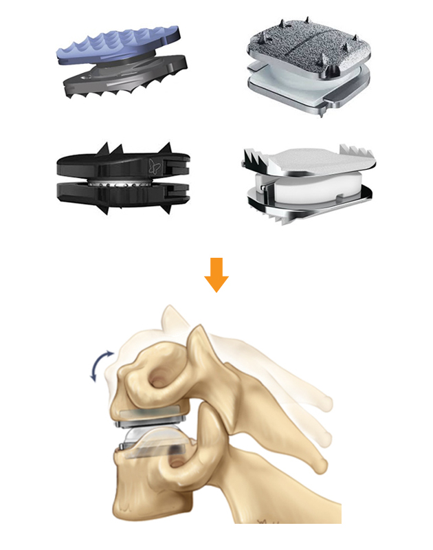 인공디스크치환술